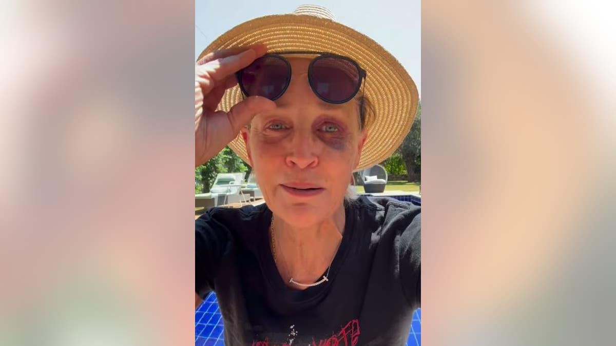 Sharon Stone with black eye by pool